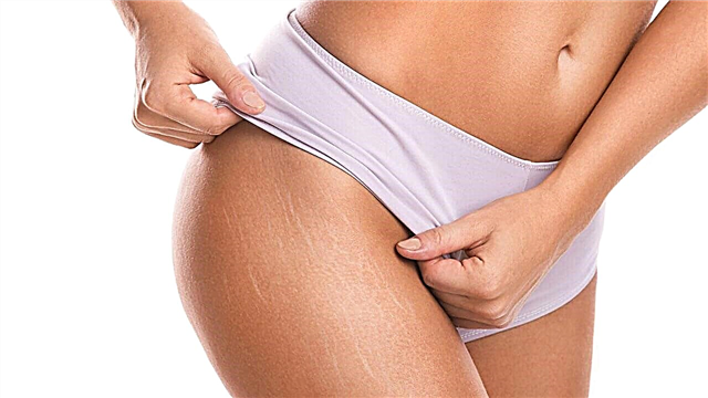 12 best remedies for stretch marks on the skin