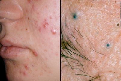 I 10 migliori trattamenti per l'acne